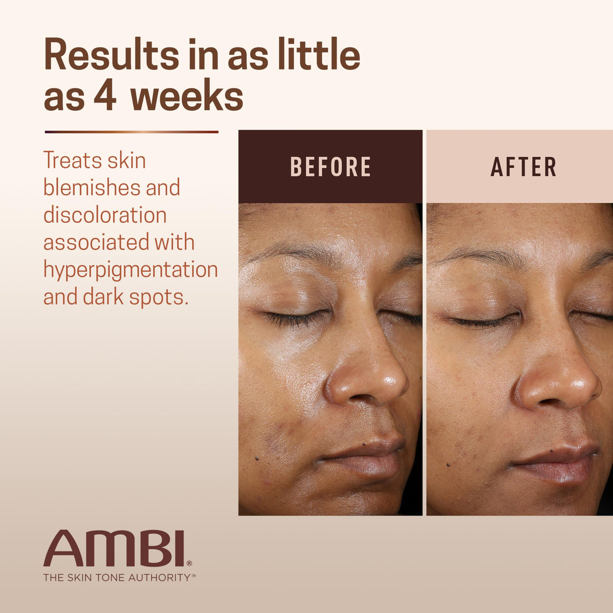 Ambi Even & Clear Advanced Fade Cream, Hydroquinone-free, Hyperpigmentation Treatment, Stubborn Dark Spot Corrector, Results In As Little As 2-3 Beauty & Personal Care Ambi