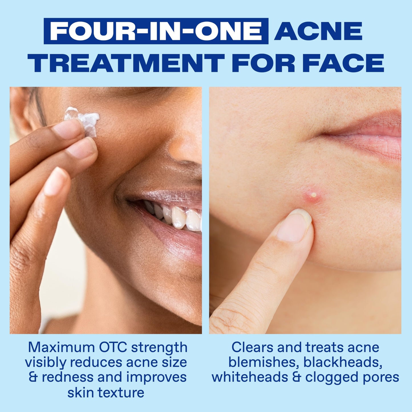 Differin Acne Spot Treatment, Max Strength, 10% Benzoyl Peroxide, 1 fl oz Beauty and Personal Care Differin
