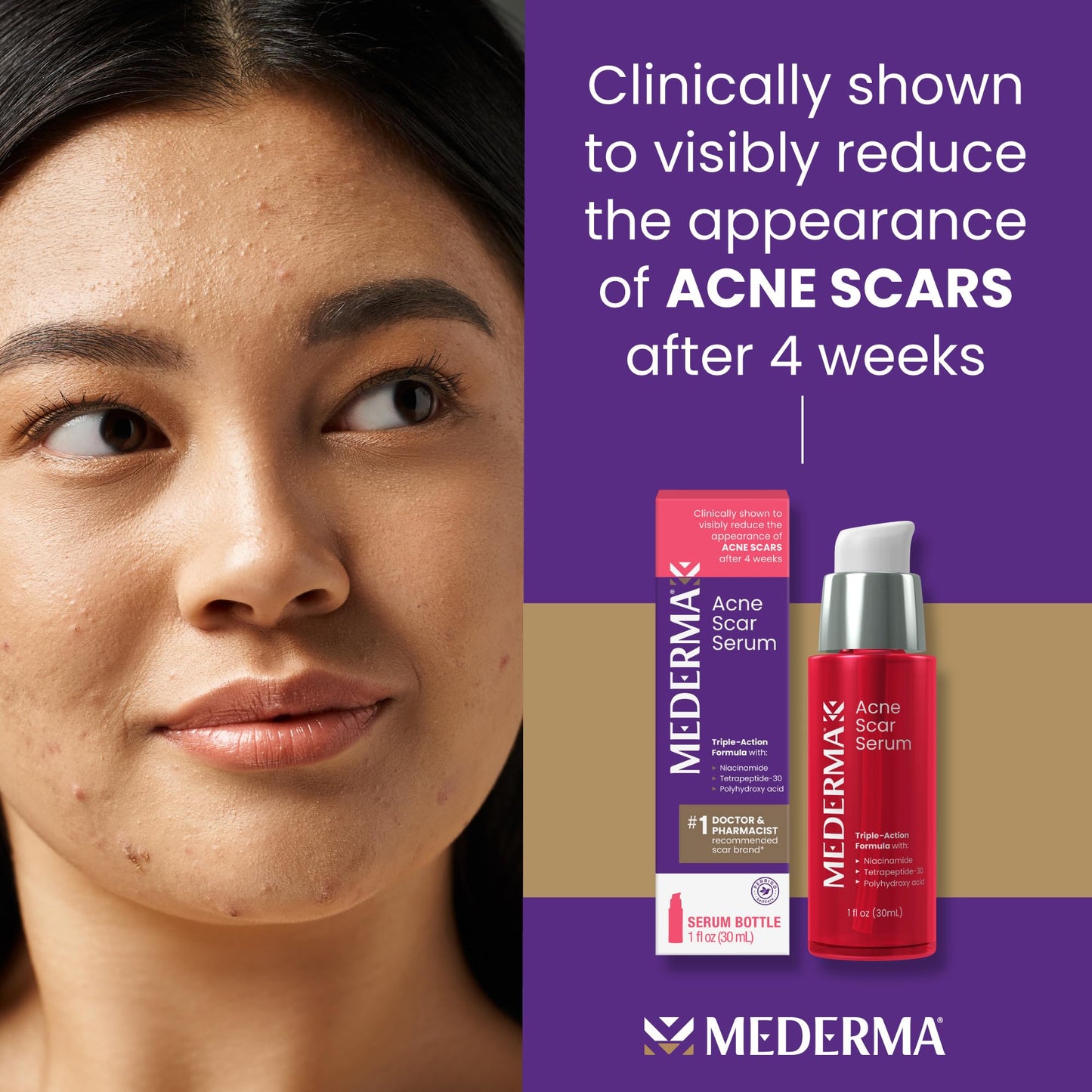 Mederma Acne Scar Serum Triple-Action Formula with Niacinamide, Tetrapeptide-30, and Polyhydroxy acid Clinically Shown to Lighten Acne Scars, 1 Fl Beauty & Personal Care Mederma