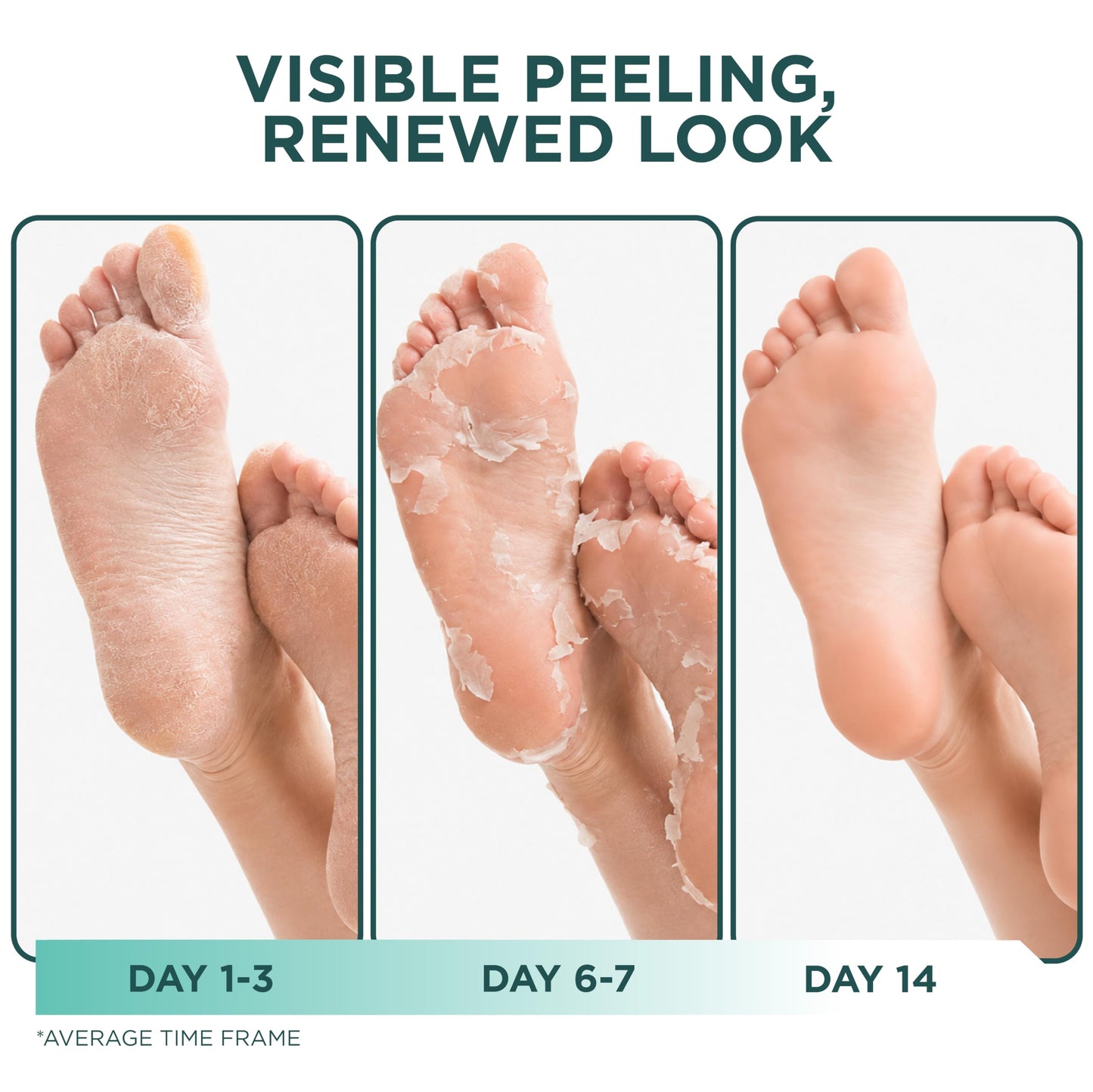 DERMORA Foot Peel Mask, Exfoliating Foot Peeling Mask, 2 Pairs, Original Beauty and Personal Care DERMORA