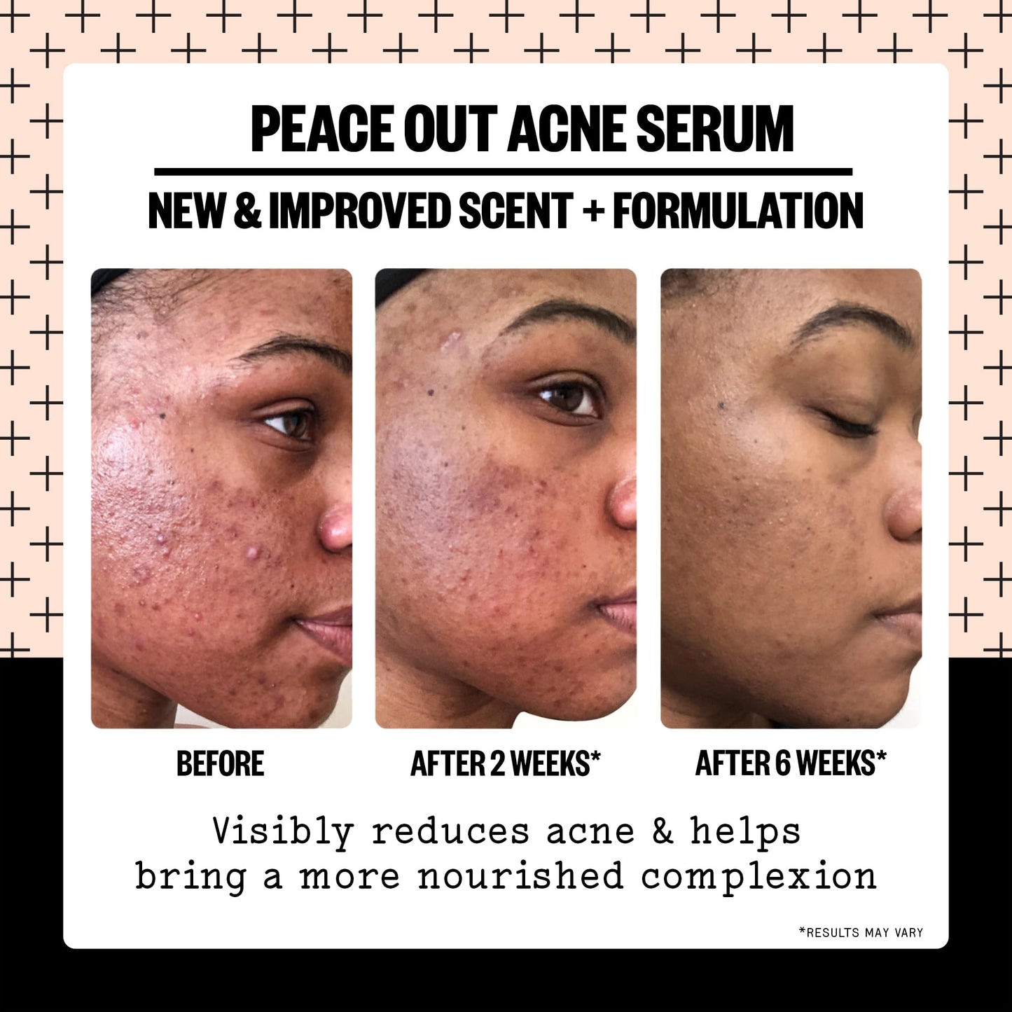 PEACE OUT Skincare Acne Serum. Daily Multi-Benefit Face Serum with 2% Salicylic Acid to Target Pimples, Zits, Blemishes and Breakouts Beauty & Personal Care PEACE OUT