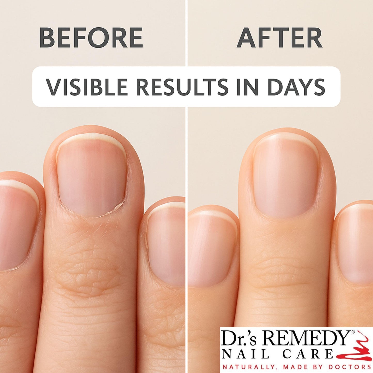 Dr.'s Remedy Therapeutic Caress Cuticle Oil, Nourishing Treatment for All Nail Types, 0.507 Fl Oz (Pack of 1) Beauty & Personal Care Dr.'s Remedy