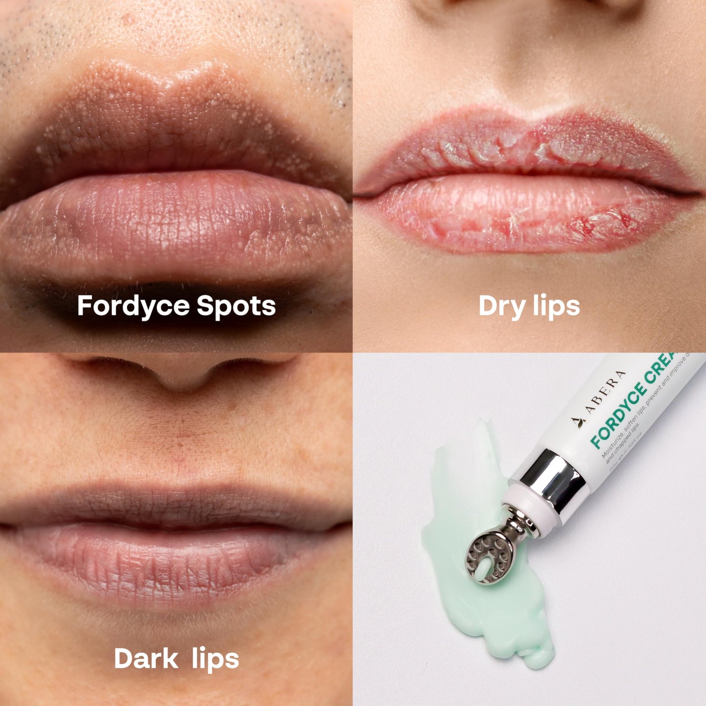 Abera Fordyce Cream - with Hydroxypinacolone retinoate(HPR), Fordyce Spot Remover For Lips, All - day Moisturizing, Help Improve Dry, Chapped and Dark Beauty and Personal Care ABERA