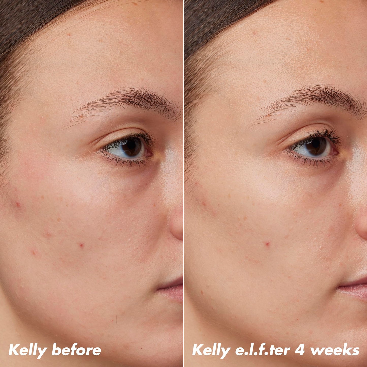 e.l.f. SKIN PLZ Clarify Facial Oil, Face Oil For Treating & Preventing Acne, Helps Calm Redness, Made with Salicylic Acid, Vegan , 1 oz Beauty & Personal Care e.l.f.