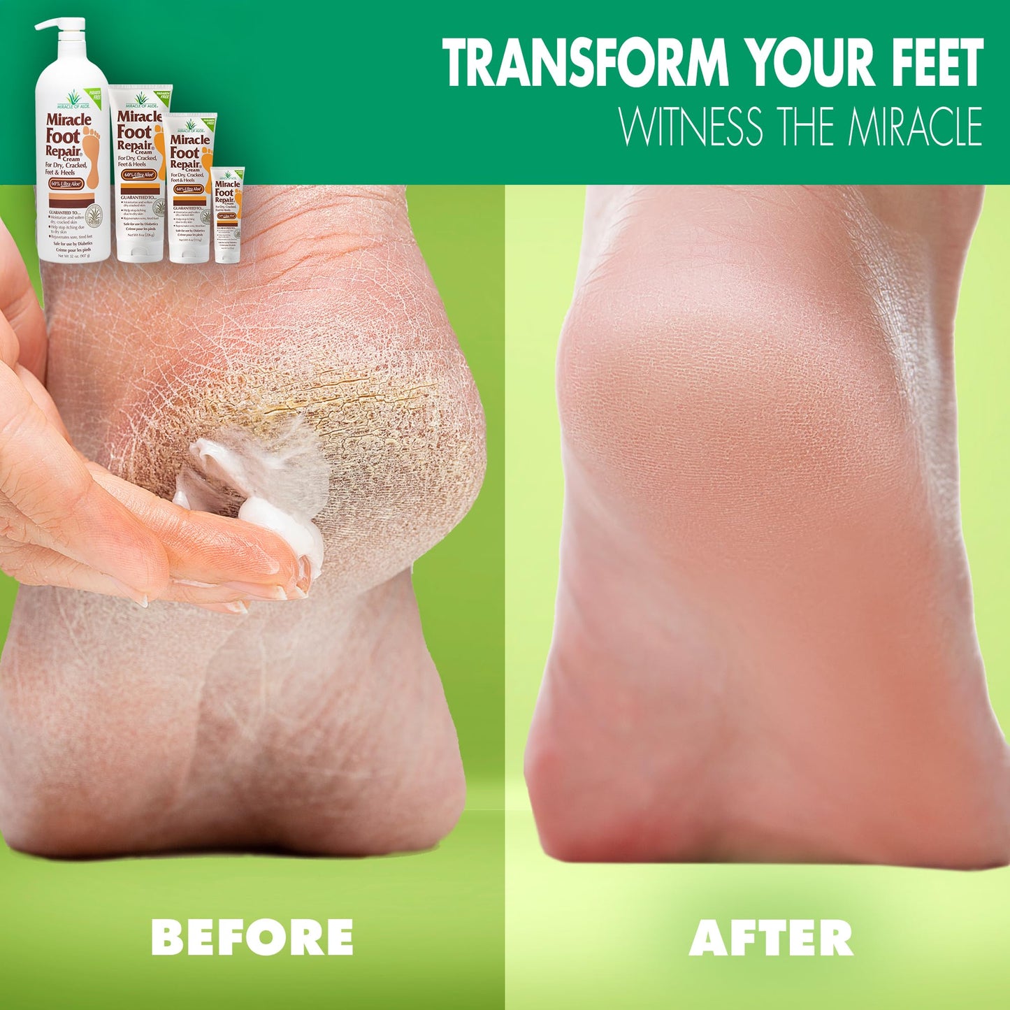 Miracle Foot Repair Cream, 4 oz Repairs Dry Cracked Heels and Feet, Diabetic-Safe, 60% Pure Ultra Aloe Moisturizes, Softens, and Repairs, Relief from Beauty & Personal Care Miracle of Aloe