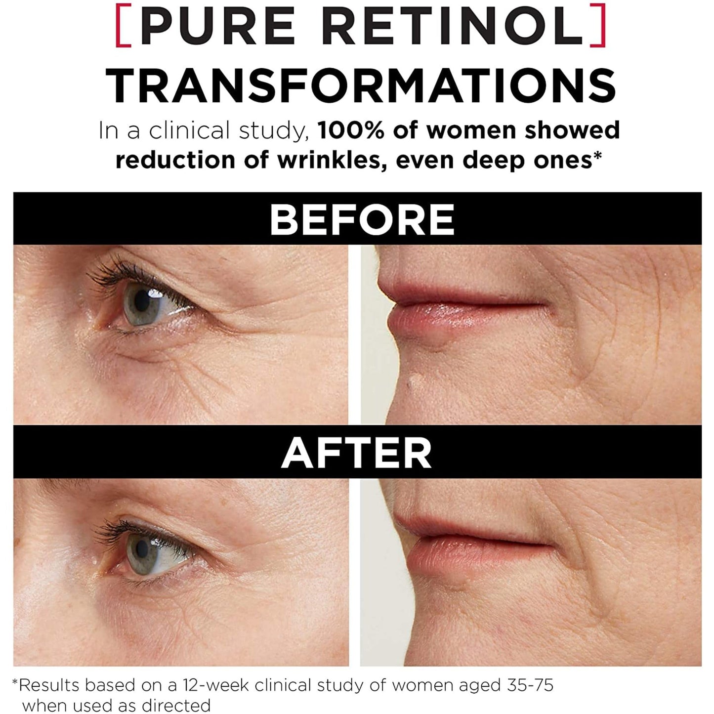 'L'Oreal Paris Revitalift Triple Power LZR Retinol Night Serum For Face, With 0.3% Pure Retinol, Moisturizes Skin and Eliminates Deep Wrinkles Beauty & Personal Care L'Oreal Paris