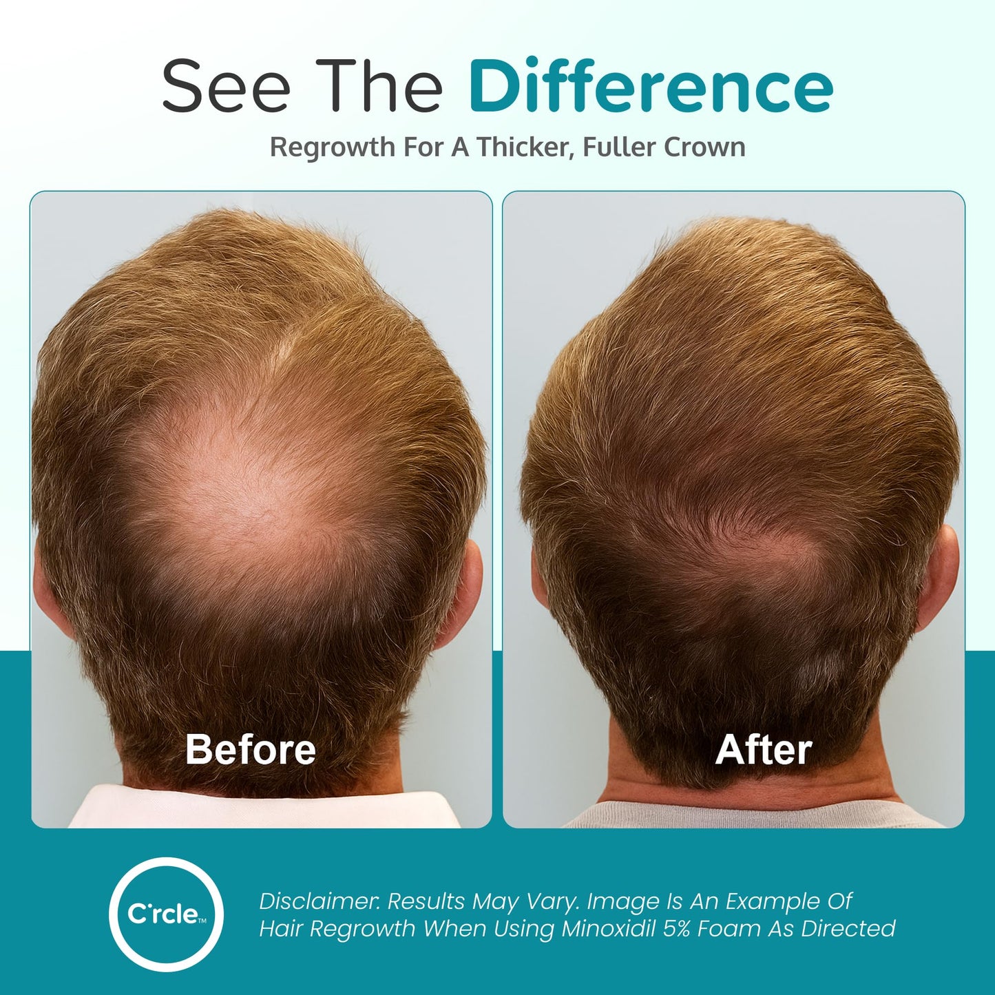 Minoxidil for Men Foam 5% - Unscented 3 Month Supply - Helps Restore Vertex Hair Loss & Thinning - 5% Minoxidil Foam For Men - Extra Strength Supports Beauty and Personal Care C'rcle