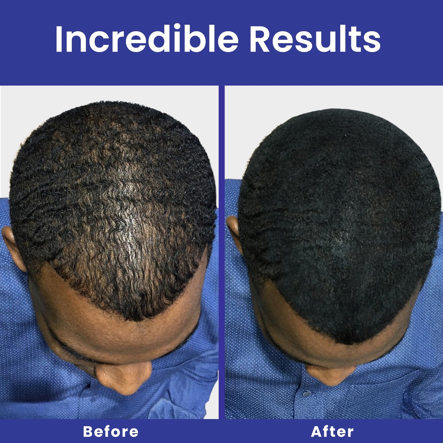 INFINITY Hair Fibers Medium Brown for Thinning Hair for Women & Men - 100% Undetectable Hair Building Fiber Powder - Conceal Hair Loss in 15 Seconds Beauty & Personal Care Infinity
