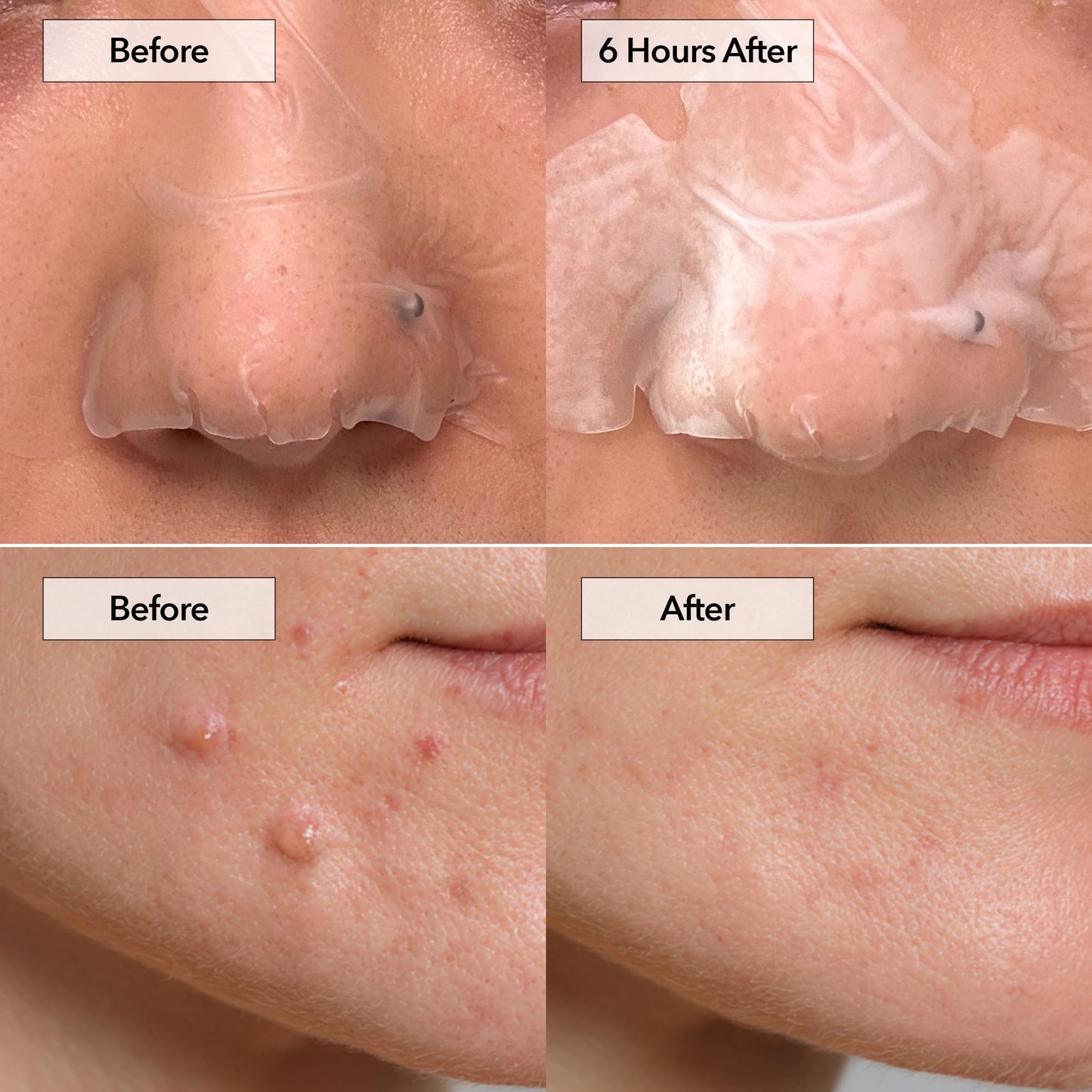 FreeGo Variety+ Hydrocolloid Spot Pimple & Pore Patches for Face, Large Patches for Breakouts, Zit, Blemish Spot, Facial Stickers, Korean Pimple Beauty & Personal Care FreeGo