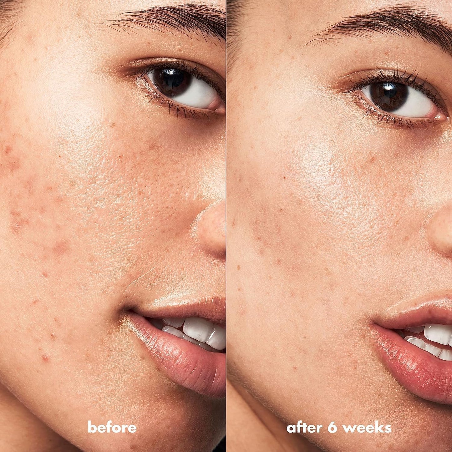 e.l.f. SKIN Blemish Breakthrough Blemish Control Basics Kit, Travel-Size Acne Skincare Routine, Cleanser, Serum & Moisturizer, Vegan & Cruelty-Free Beauty & Personal Care e.l.f.