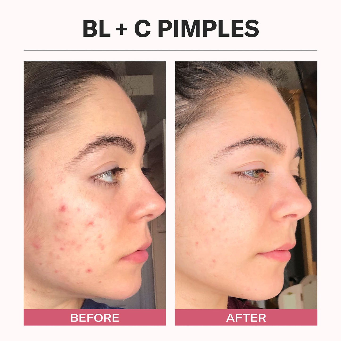 Odacité Bl+C Serum Concentrate for Face, Luxury Black Cumin + Cajeput Pore-Clearing Facial Oil for Pimples & Blemishes, Vegan Vitamin E Spot Treatment Beauty & Personal Care ODACITE
