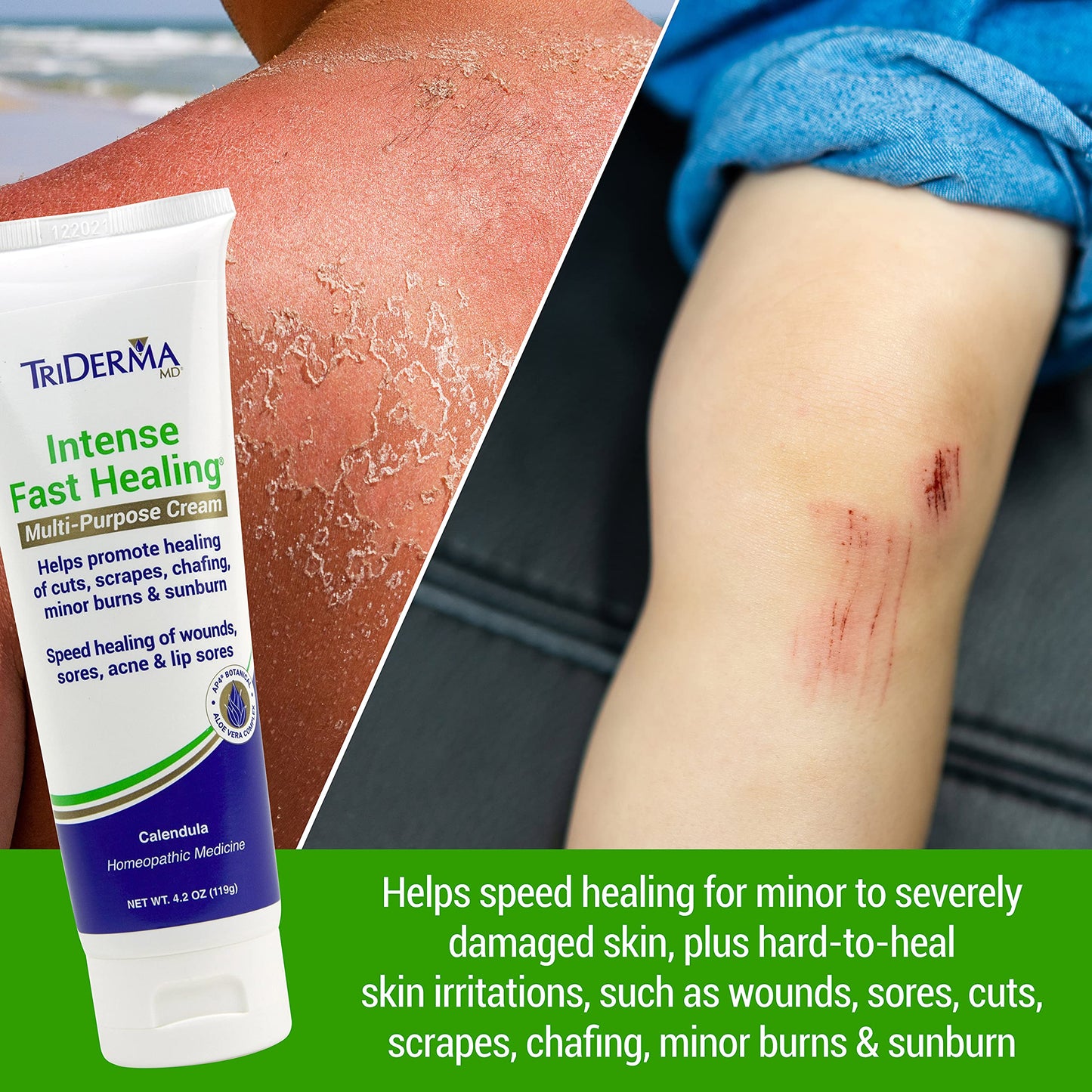 TriDerma Intense Fast Skin Healing Cream for Hard-to-Heal Skin Irritations, Sores, Rashes, Dry, Cracked Hands, Cuts, Chafing, Burns, Scrapes - First Beauty & Personal Care TriDerma