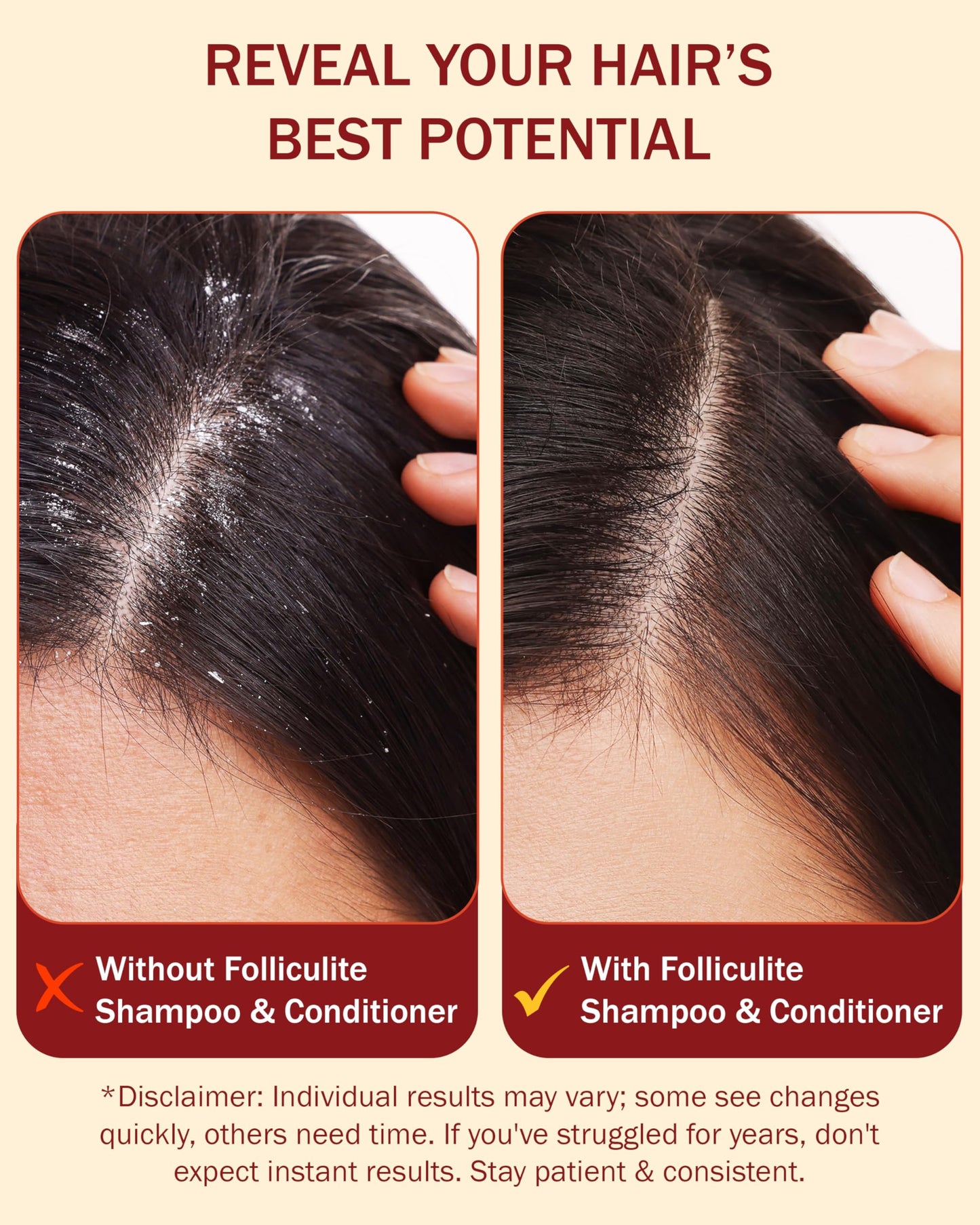 Folliculitis Treatment Shampoo and Conditioner with 3% BHA, Salicylic Acid, Aloe Vera & Tea Tree Oil - Anti Itch Shampoo for women & men with Flaky Beauty & Personal Care e70