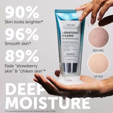 Keratosis Pilaris Lotion with Glycolic Acid, AHA & BHA Exfoliating | Strawberry Legs, KP & Ingrown Hair Treatment | Bumpy Skin Body Lotion | Moisturizing Cream for Redness, Dry, Rough & Flakey Skin