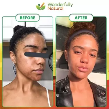Organic African Black Soap - For Acne & Dark Spots...