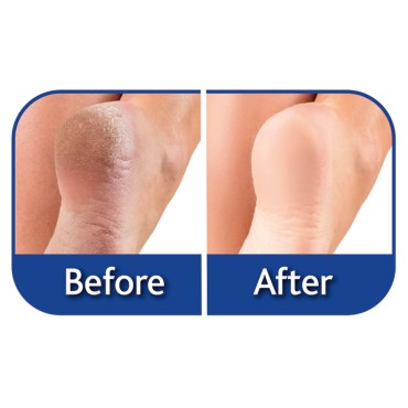 Ontel Genie Feet Exfoliating Foot Peel Cream, 4 Ou...